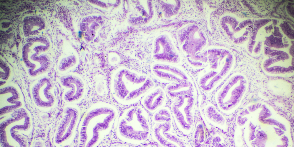Dr Amer Raza – Understanding the Differences Between Adenomyosis and Endometriosis Dr Amer Raza - Understanding the Differences Between Adenomyosis and Endometriosis