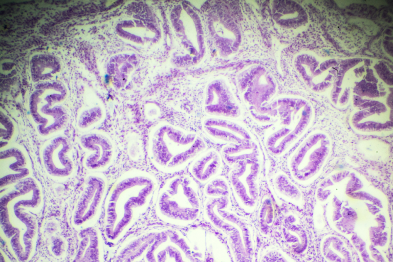 Dr Amer Raza - Understanding the Differences Between Adenomyosis and Endometriosis