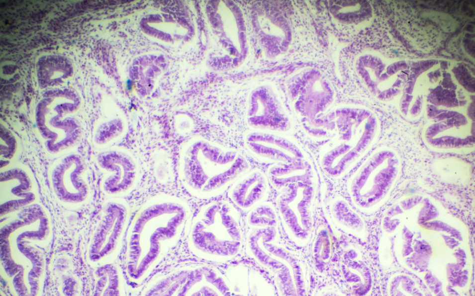 Dr Amer Raza - Understanding the Differences Between Adenomyosis and Endometriosis