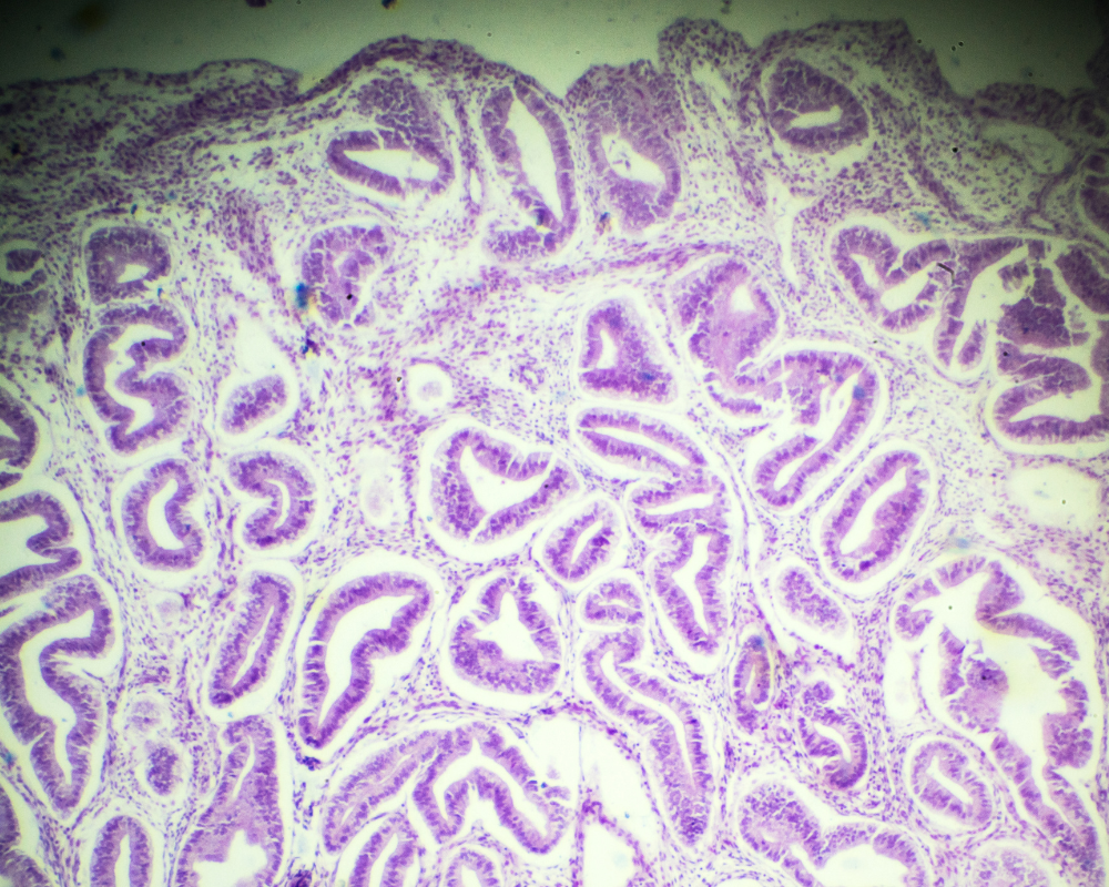 Dr Amer Raza - Understanding the Differences Between Adenomyosis and Endometriosis
