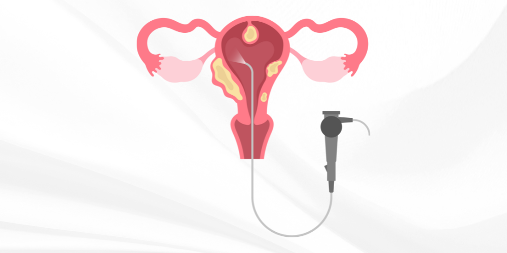 Dr Amer Raza -Hysterectomy – A Cure for Endometriosis Dr Amer Raza -Hysterectomy – A Cure for Endometriosis