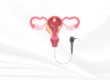 Dr Amer Raza -Hysterectomy – A Cure for Endometriosis