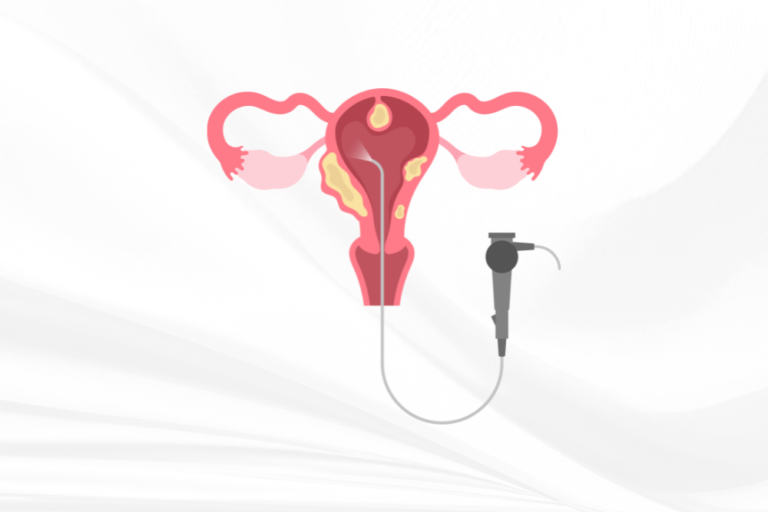 Dr Amer Raza -Hysterectomy – A Cure for Endometriosis