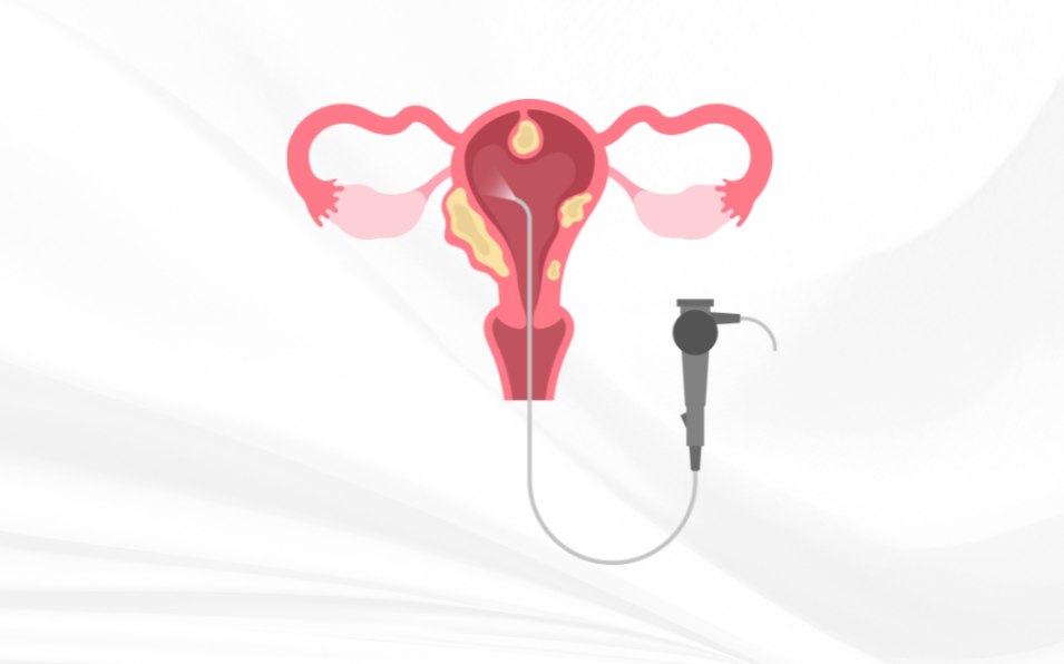 Dr Amer Raza -Hysterectomy – A Cure for Endometriosis