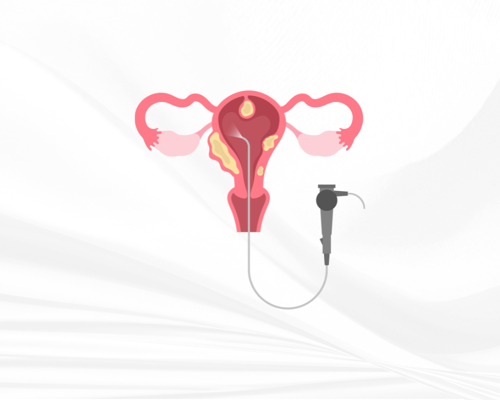 Dr Amer Raza -Hysterectomy – A Cure for Endometriosis