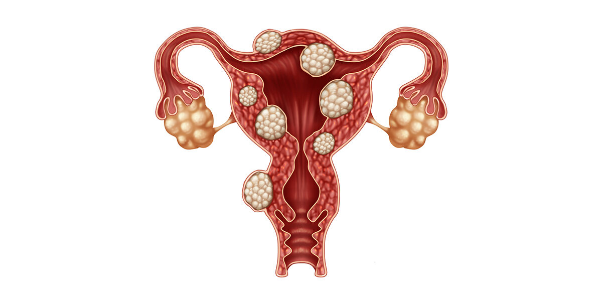 Uterine Fibroids – Mr Amer Raza Uterine Fibroids - Mr Amer Raza