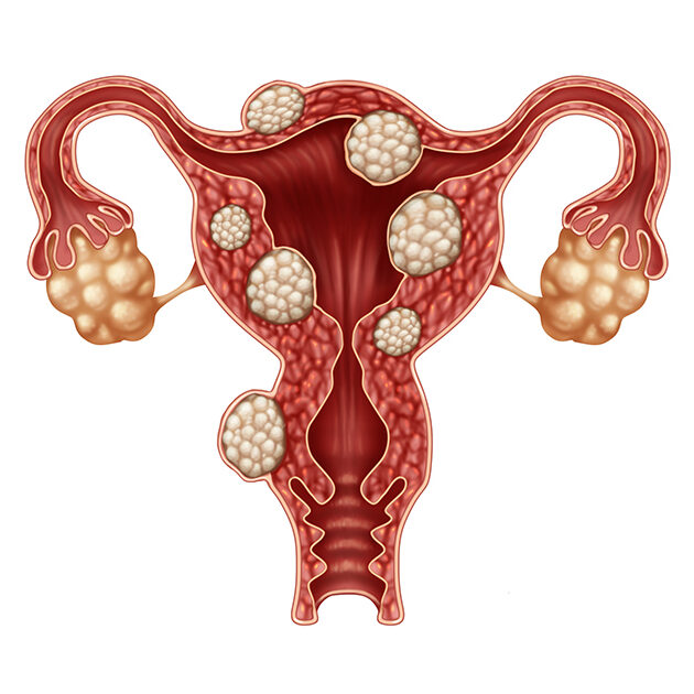 Uterine Fibroids – Mr Amer Raza Uterine Fibroids - Mr Amer Raza