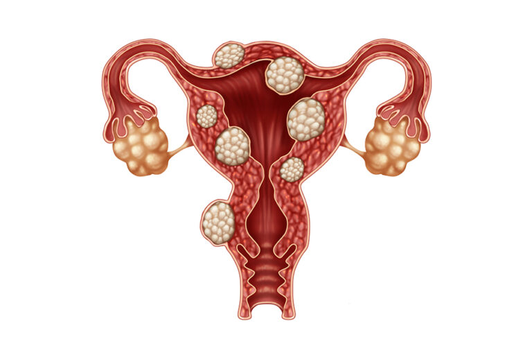 Uterine Fibroids - Mr Amer Raza