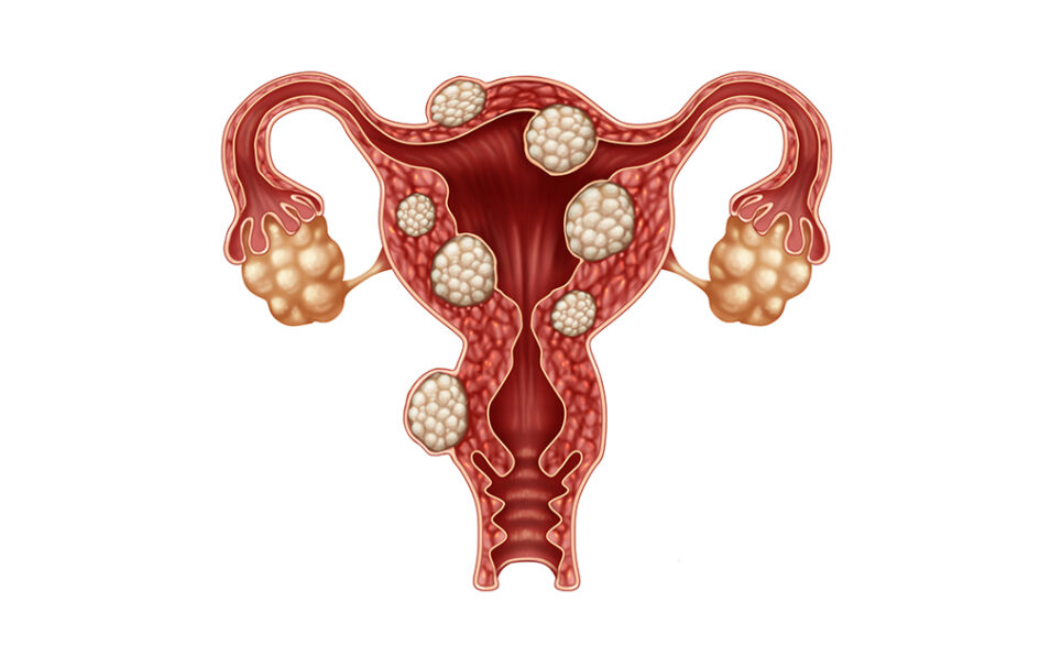 Uterine Fibroids - Mr Amer Raza