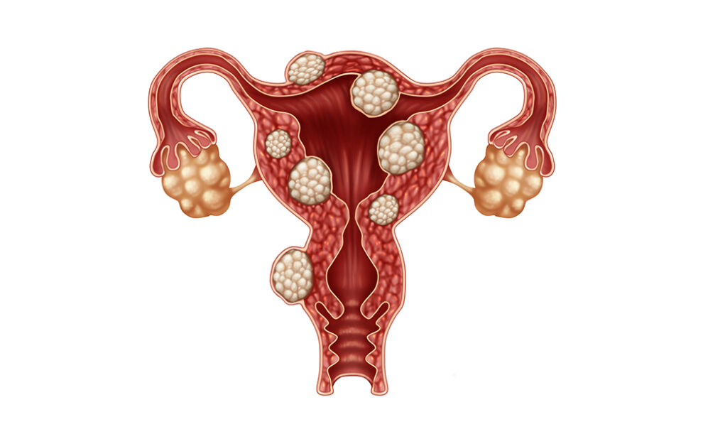 Uterine Fibroids - Mr Amer Raza