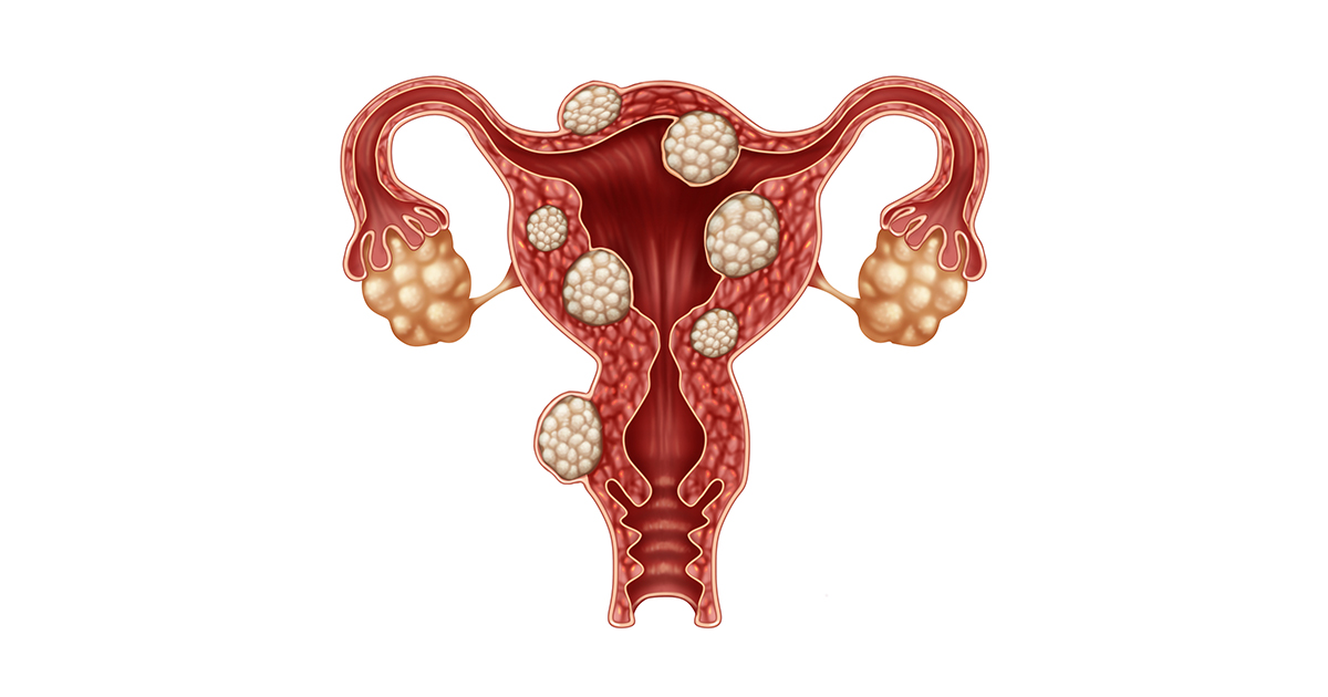 Uterine Fibroids - Mr Amer Raza
